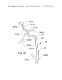 Systems And Methods For Removing Obstructive Matter From Body Lumens And     Treating Vascular Defects diagram and image