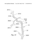 Systems And Methods For Removing Obstructive Matter From Body Lumens And     Treating Vascular Defects diagram and image