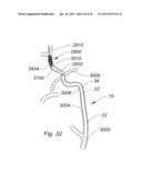 Systems And Methods For Removing Obstructive Matter From Body Lumens And     Treating Vascular Defects diagram and image