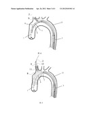 DELIVERY SYSTEM FOR BRANCHED STENT GRAFT diagram and image