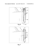 ENDOSCOPIC IMPLANTABLE DEVICE AND METHOD FOR THE APPOSITION OF THE STOMACH     WALLS FOR REDUCING THE STOMACH INTERNAL VOLUME IN A WEIGHT LOSS SURGERY     PROCEDURE diagram and image