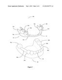 Removable Partial Dental Prosthesis diagram and image