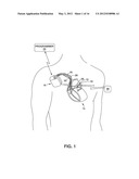 Implantable Medical Sensor and Fixation System diagram and image