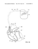 IMPLANTABLE SYSTEMIC BLOOD PRESSURE MEASUREMENT SYSTEMS AND METHODS diagram and image