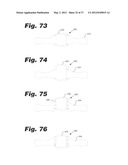 APPARATUS AND METHOD FOR ULTRASONIC SPINE TREATMENT diagram and image