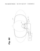 APPARATUS AND METHOD FOR ULTRASONIC SPINE TREATMENT diagram and image