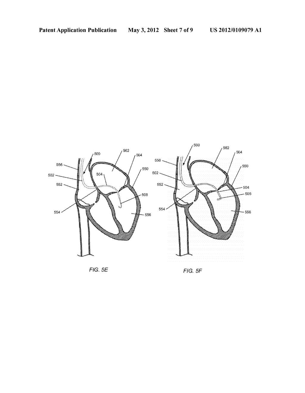 Telescoping Catheter Delivery System for Left Heart Endocardial Device     Placement - diagram, schematic, and image 08