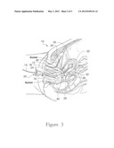 ELECTROSURGICAL ELEMENT AND UTERINE MANIPULATOR FOR TOTAL LAPAROSCOPIC     HYSTERECTOMY diagram and image