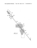 Device And Method For Use During Ligament Reconstruction diagram and image