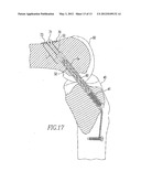 Device And Method For Use During Ligament Reconstruction diagram and image