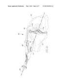 OVAL TIBIA GUIDE diagram and image