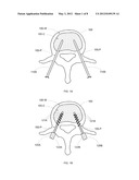 REDUCED EXTRAVASATION OF BONE CEMENT diagram and image