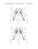 REDUCED EXTRAVASATION OF BONE CEMENT diagram and image