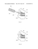 REDUCED EXTRAVASATION OF BONE CEMENT diagram and image