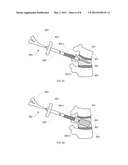 REDUCED EXTRAVASATION OF BONE CEMENT diagram and image