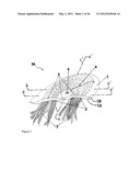 ELEMENTS FOR VERSATILITY OF A PROSTHETIC ANCHOR diagram and image