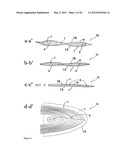 ELEMENTS FOR VERSATILITY OF A PROSTHETIC ANCHOR diagram and image