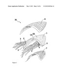 ELEMENTS FOR VERSATILITY OF A PROSTHETIC ANCHOR diagram and image