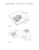 ELEMENTS FOR VERSATILITY OF A PROSTHETIC ANCHOR diagram and image