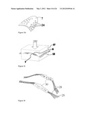 ELEMENTS FOR VERSATILITY OF A PROSTHETIC ANCHOR diagram and image