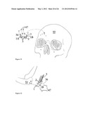 ELEMENTS FOR VERSATILITY OF A PROSTHETIC ANCHOR diagram and image