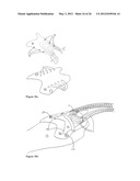 ELEMENTS FOR VERSATILITY OF A PROSTHETIC ANCHOR diagram and image