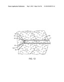 METHODS AND DEVICES FOR REMOVING TISSUE FROM A PATIENT AND PLACING A     MARKER IN THE PATIENT diagram and image