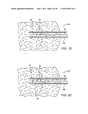 METHODS AND DEVICES FOR REMOVING TISSUE FROM A PATIENT AND PLACING A     MARKER IN THE PATIENT diagram and image