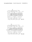 METHODS AND DEVICES FOR REMOVING TISSUE FROM A PATIENT AND PLACING A     MARKER IN THE PATIENT diagram and image