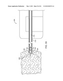 METHODS AND DEVICES FOR REMOVING TISSUE FROM A PATIENT AND PLACING A     MARKER IN THE PATIENT diagram and image