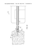 METHODS AND DEVICES FOR REMOVING TISSUE FROM A PATIENT AND PLACING A     MARKER IN THE PATIENT diagram and image