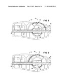 Method of Performing a Suprapubic Transurethral Cystostomy diagram and image