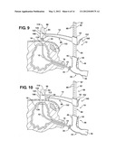 Method of Performing a Suprapubic Transurethral Cystostomy diagram and image