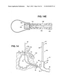 Method of Performing a Suprapubic Transurethral Cystostomy diagram and image