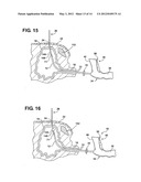 Method of Performing a Suprapubic Transurethral Cystostomy diagram and image