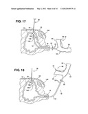 Method of Performing a Suprapubic Transurethral Cystostomy diagram and image