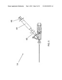 ADHESIVE-BASED VARICOSE VEIN TREATMENT diagram and image