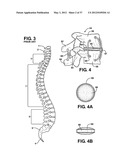 ASSEMBLEABLE JACK BRACES FOR SEATING AND SUPPORTING ANGULAR PROCESSES diagram and image