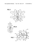 ASSEMBLEABLE JACK BRACES FOR SEATING AND SUPPORTING ANGULAR PROCESSES diagram and image