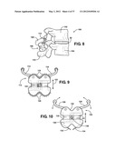 ASSEMBLEABLE JACK BRACES FOR SEATING AND SUPPORTING ANGULAR PROCESSES diagram and image