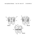 ASSEMBLEABLE JACK BRACES FOR SEATING AND SUPPORTING ANGULAR PROCESSES diagram and image