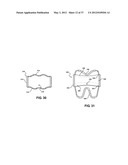 ASSEMBLEABLE JACK BRACES FOR SEATING AND SUPPORTING ANGULAR PROCESSES diagram and image