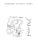 ASSEMBLEABLE JACK BRACES FOR SEATING AND SUPPORTING ANGULAR PROCESSES diagram and image