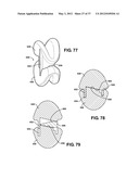 ASSEMBLEABLE JACK BRACES FOR SEATING AND SUPPORTING ANGULAR PROCESSES diagram and image