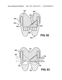 ASSEMBLEABLE JACK BRACES FOR SEATING AND SUPPORTING ANGULAR PROCESSES diagram and image