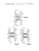 ASSEMBLEABLE JACK BRACES FOR SEATING AND SUPPORTING ANGULAR PROCESSES diagram and image