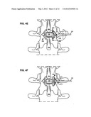 Systems and Methods for In Situ Assembly of an Interspinous Process     Distraction Implant diagram and image