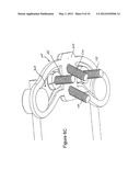 OCCIPITAL FIXATION SYSTEM AND METHOD OF USE diagram and image