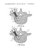 Removable Anchoring Pedicle Screw diagram and image