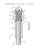 Removable Anchoring Pedicle Screw diagram and image